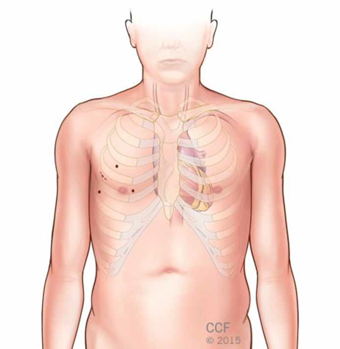 minimally invasive and robotically assisted heart surgery 7.png